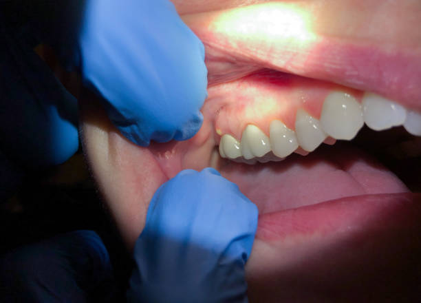 Best Chipped Tooth Repair Near Me  in Franklin, LA