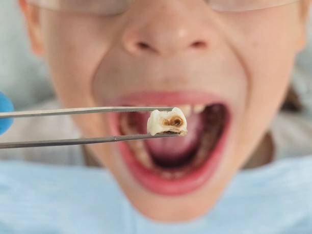 Best Root Canal Emergency Dentist  in Franklin, LA